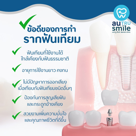 ข้อดีของการทำรากฟันเทียม